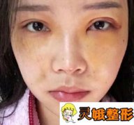 在扬州苏北人民医院整形科做了面部填充，案例分享【亲测】
