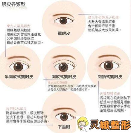 双眼皮手术的类型