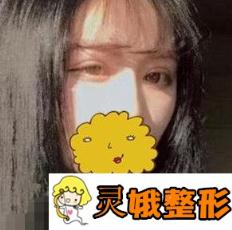 广州美莱双眼皮修复案例与你们分享，修复后完全不同了!