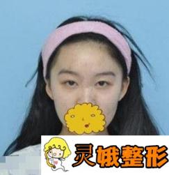 广州美莱双眼皮修复案例与你们分享，修复后完全不同了!