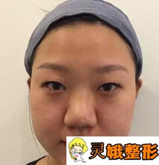 刘芳整形做双眼皮恢复之后，眼睛还是增大了很多