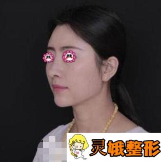 【美鼻日记】刘彦军做的假体隆鼻360度拍照无死角
