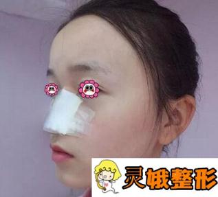 　在北京艺星做的歪鼻矫正三个月就好得和真鼻没什么两样