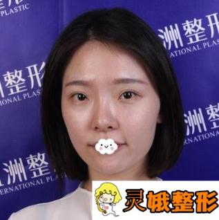 找刘骏医生做完隆鼻失败修复，鼻子终于变成了我想要的样子