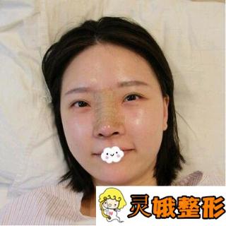 找刘骏医生做完隆鼻失败修复，鼻子终于变成了我想要的样子
