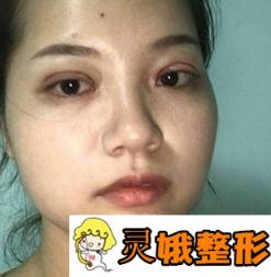 宁波市第二医院整形外科价格表，附胡锡浩双眼皮果展示