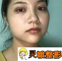 宁波市第二医院整形外科价格表，附胡锡浩双眼皮果展示