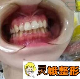 衢州口腔医院价格表，附牙齿矫正案例分享