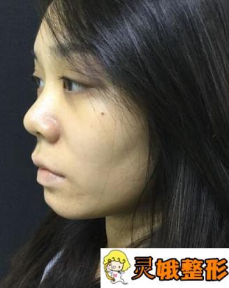 【案例分享】北京韩式耳软骨隆鼻果怎么样？变成天然美鼻不是梦