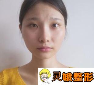海南省人民医院整形美容科面部填充案例成经典，价格表2020版流出