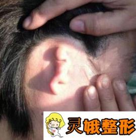 广东省第二人民医院整形科小耳畸形果分享，价格表2020公布