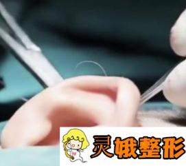 广东省第二人民医院整形科小耳畸形果分享，价格表2020公布
