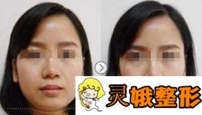北京注射瘦脸多少钱？一支价格是多少？价格收费详情说明