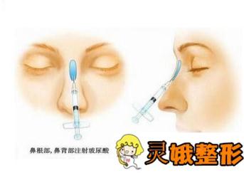 韩式注射式隆鼻没问题吗？警惕这几项帮你提前预防副作用