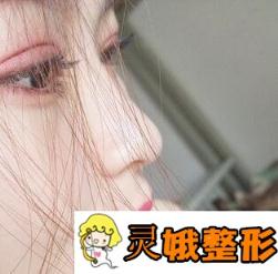 深圳北大医院整形科价格表已公布出炉，附双眼皮整形案例