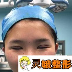 上海长征医院整形科双眼皮亲身经历及医生推荐，还有【价格表】