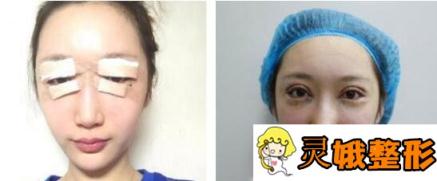 北京煤医李敏双眼皮修复