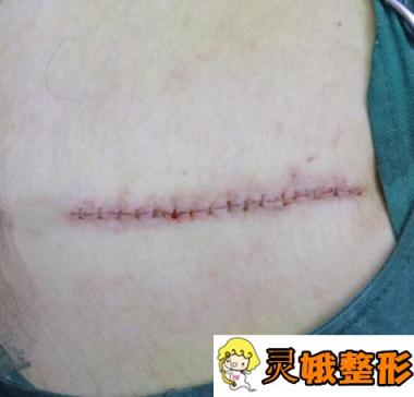 上海虹桥医院整形美容整形科祛疤