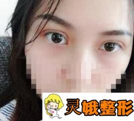 上海长征医院整形外科双眼皮案例