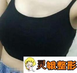 湖南省第二人民医院整形美容科胸部案例