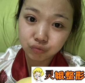 杭州瑞丽医疗美容医院价格表，附双眼皮手术经历分享