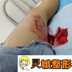 浙江杭州萧山医院烧伤整形科价格表附真实祛疤案例分享