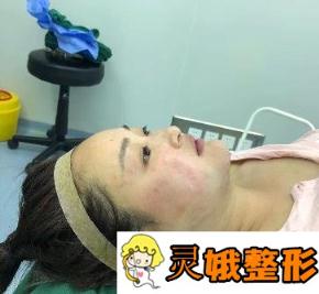 黑龙江省医院整形颌面外科怎么样_价格表_颧骨磨骨案例分享