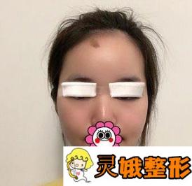 2019北京京民整形价格表震撼发布，附双眼皮案例