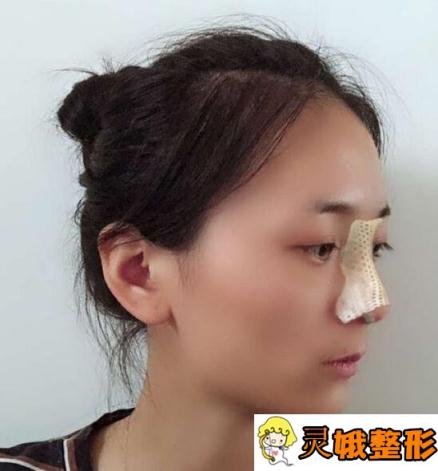 上海韩嘉毅医生做鼻子怎么样？做完鼻子半年经历分享