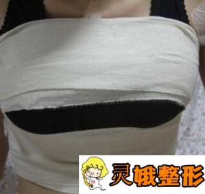 北京八大处自体脂肪隆胸案例