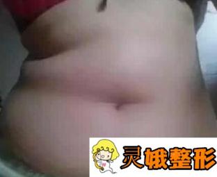 广州华美腰腹吸脂案例