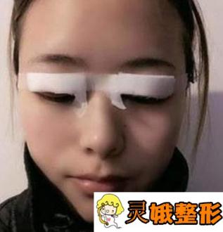 甘肃省人民医院整形美容科价格表惊喜一览，含医院双眼皮案例展示