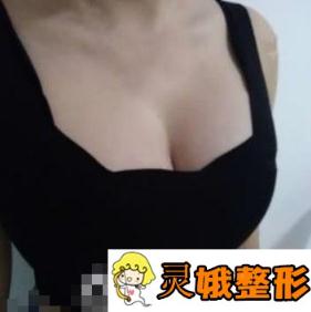 北京八大处乳房下垂矫正真的是宝藏，我的胸变得又大又挺