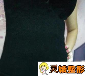 广州华美腰部吸脂真人案例分享，一个月就能拥有明星的A4腰