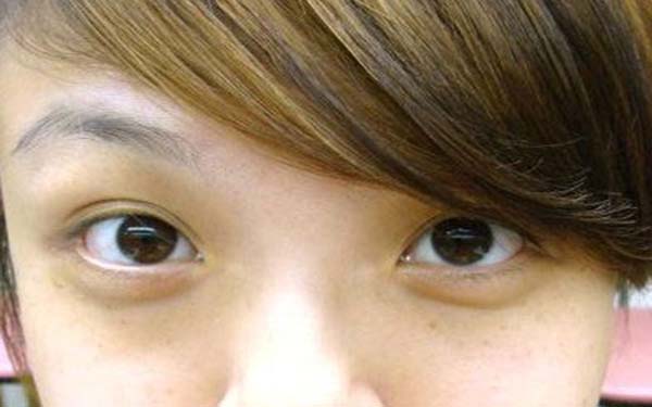 去除黑眼圈方法，手术去除黑眼圈果好吗？