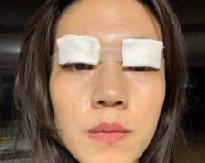 广医大附属第一医院做双眼皮技术好不好？来看个人案例记录吧