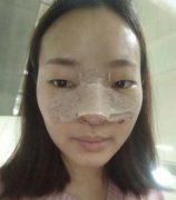 案例来袭~来看看我在深圳鹏程医院做的鼻部整形手术