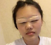 跑到韩国去做双眼皮手术没想到失败啦！来看我是如何修复的吧