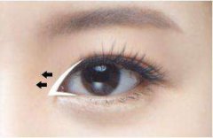 双眼皮是如何形成的？从专业角度剖析双眼皮手术