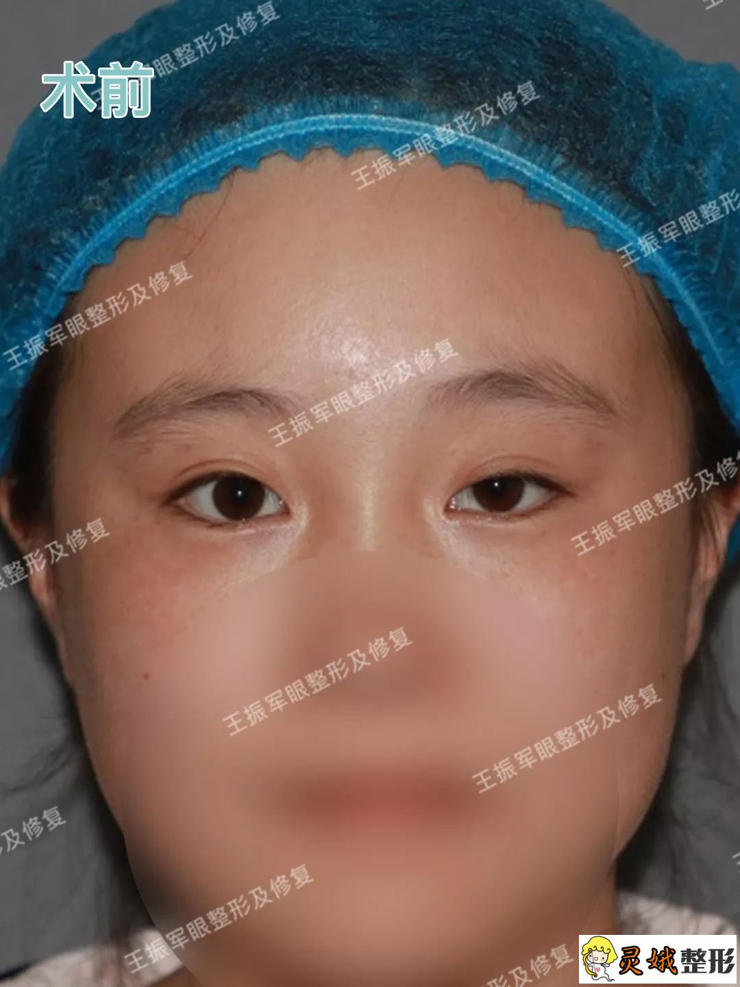 想要变美整形手术要控制好度,左侧双眼皮手术和右侧上睑下垂修复案例！