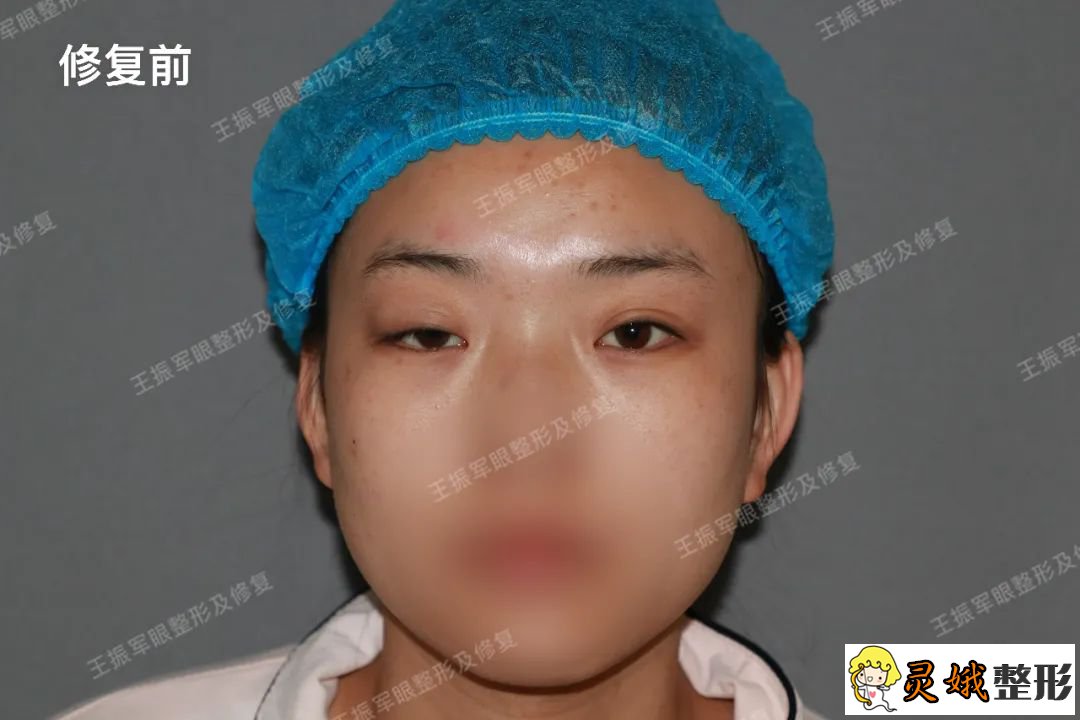 割双眼皮手术居然做成了上睑下垂，看上睑下垂修复手术真实案例！