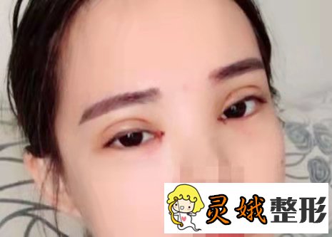 中月宏医生怎么样?附双眼皮案例分享，眼睛变美不是一个度！