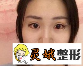 【案例】北京开外眼角手术果真是好，真人果图来喽！