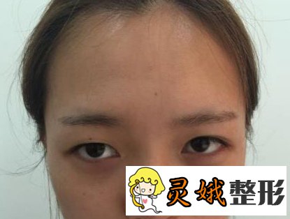 （案例）北京生物焊接双眼皮整个过程展示，让眼睛变美！