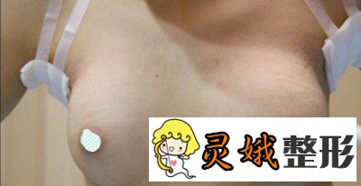 姚桃琴面假体隆胸真实案例图展示，原来胸真的可以变挺！