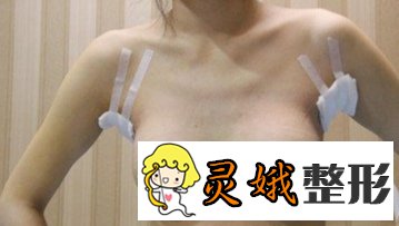 姚桃琴面假体隆胸真实案例图展示，原来胸真的可以变挺！