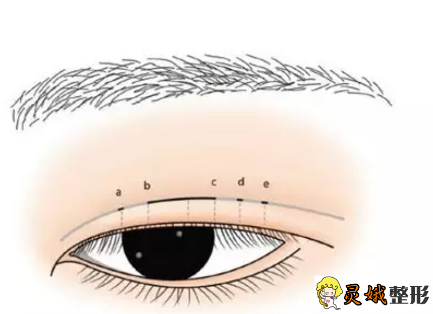 埋线双眼皮果图之埋线双眼皮手术方式、术后恢复