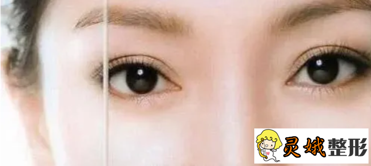 韩式三点定位双眼皮价格，双眼皮术后处理及注意事项