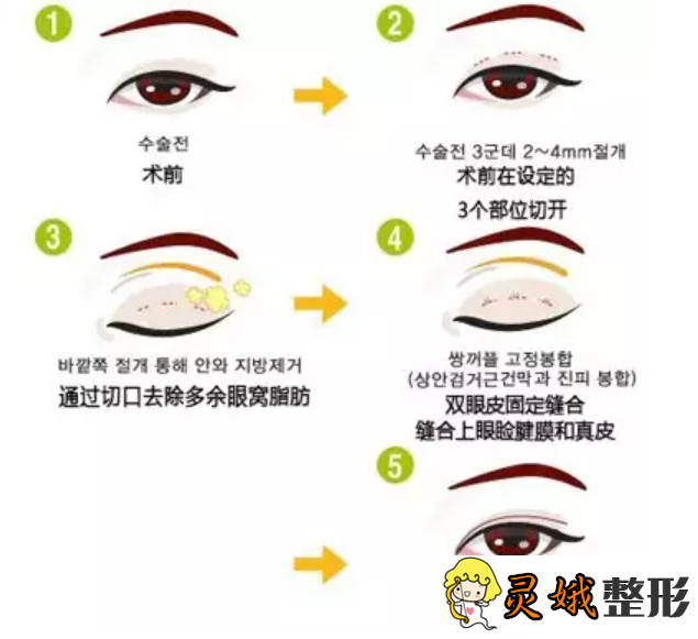 韩国双眼皮手术优势之韩国双眼皮手术怎么选