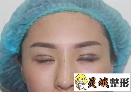 苏州双眼皮医生排名之刘武林医生全切双眼皮案例